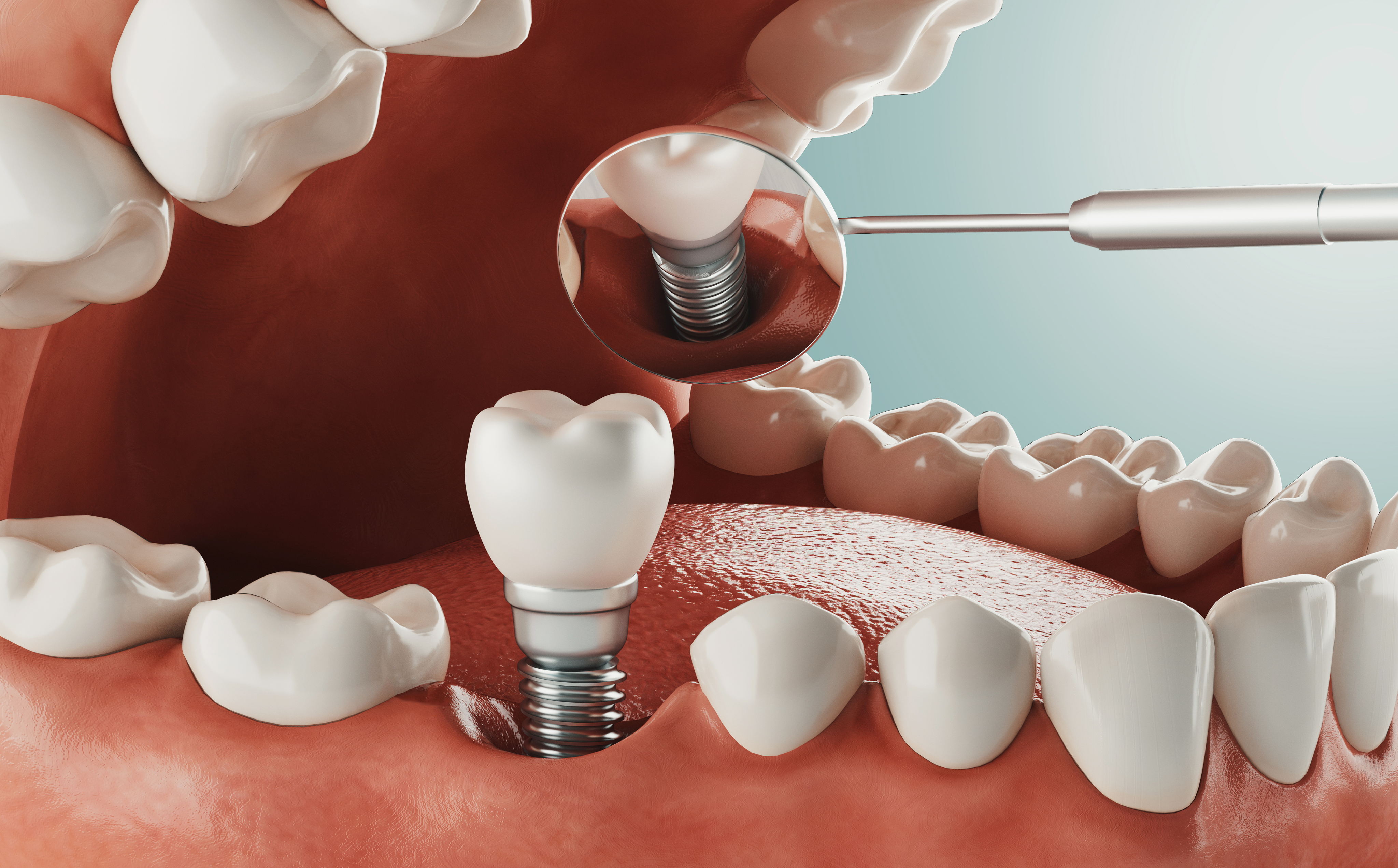 Implants dentaires